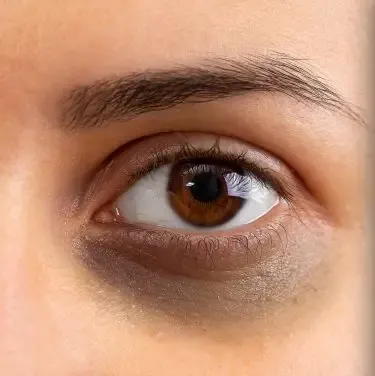 What Is The Most Effective Dark Circles Remedy? by fatimadynamic