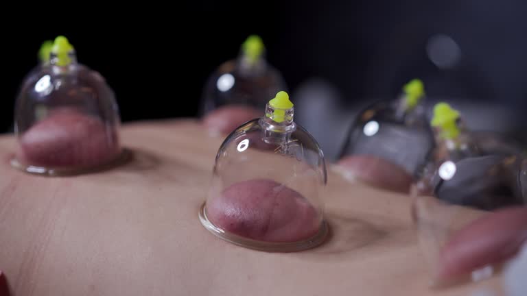 Discover The Secrets To Vitality With Hijama Cupping Therapy by pookie46