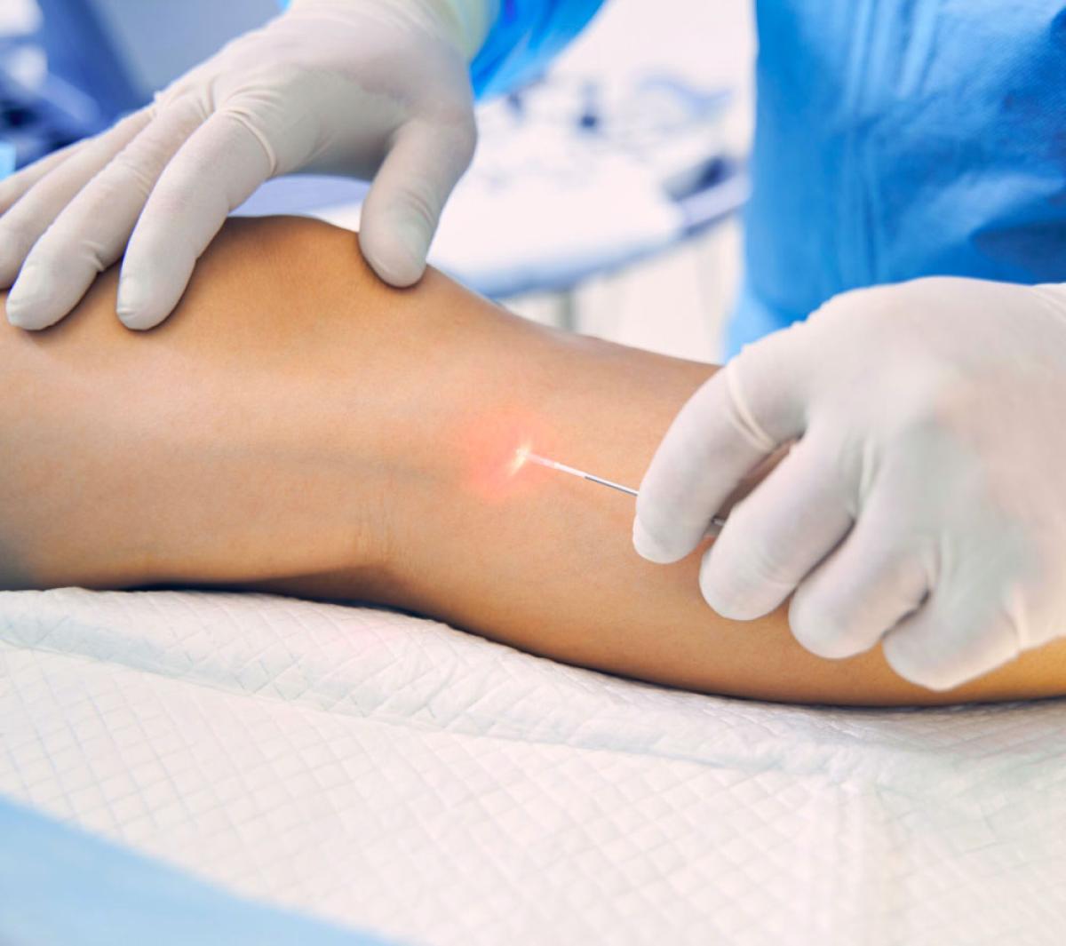 What Is The Typical Post-Sclerotherapy Care Process? by Ahmad Hassan