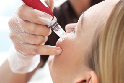 How Many Microneedling Sessions Are Needed? by dynamicaesthetic