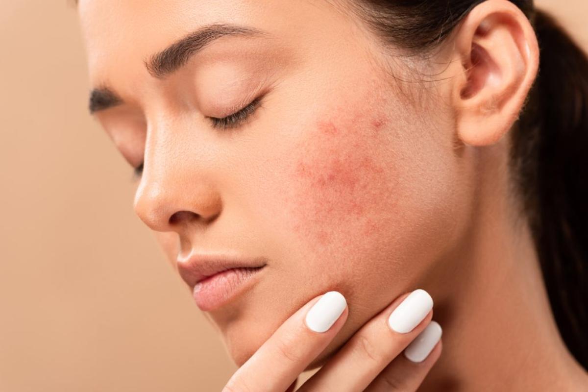 Which Pimples Treatment Works Best For Darker Skin Tones? by dynamicaesthetic