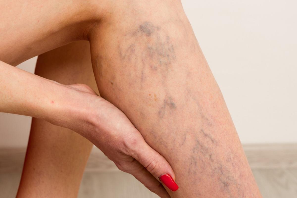 How Many Sessions Are Typically Required For Varicose Vein Treatment? by cdynmic