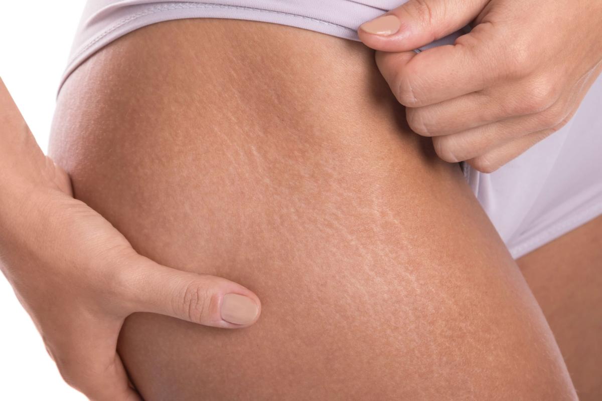 Is Stretch Marks Removal Evidence Based? by MuhammadAhmad