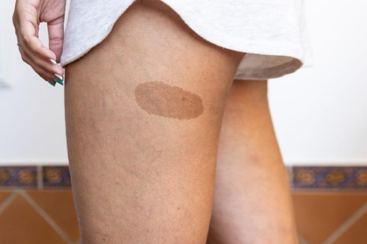 Can All Skin Tones Undergo Birthmarks Removal Treatment? by fatimadynamic