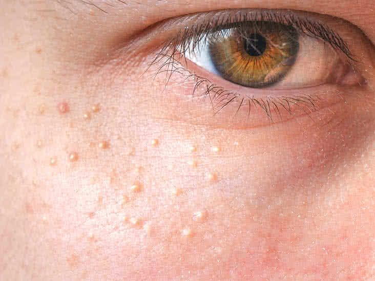What Exactly Are Milia And How Can They Be Treated Effectively? by dynamicaesthetic
