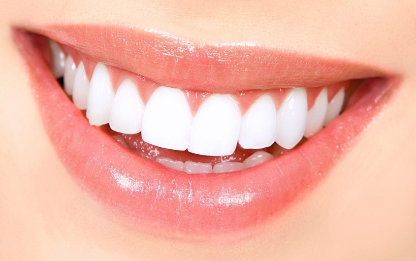 What Are Dental Veneers Commonly Made From? by Taimoor Tahir