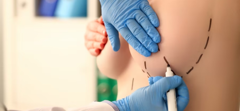 What Is Breast Lift Surgery? by Dynamicclinic12