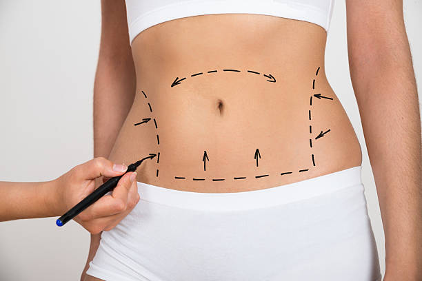 Does Tummy Tuck Tighten Loose Skin? by Enfieldabudhabi