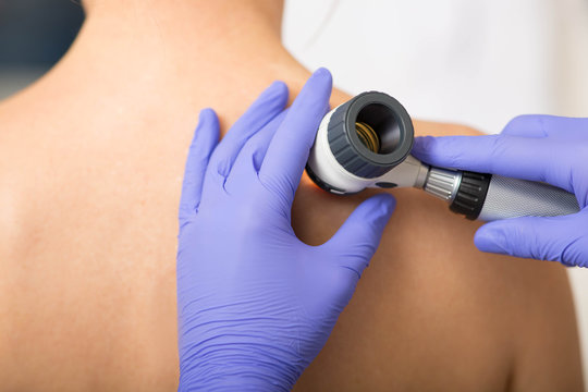 What Are The Benefits Of Dermoscopy Mole Check? by dynamicaesthetic