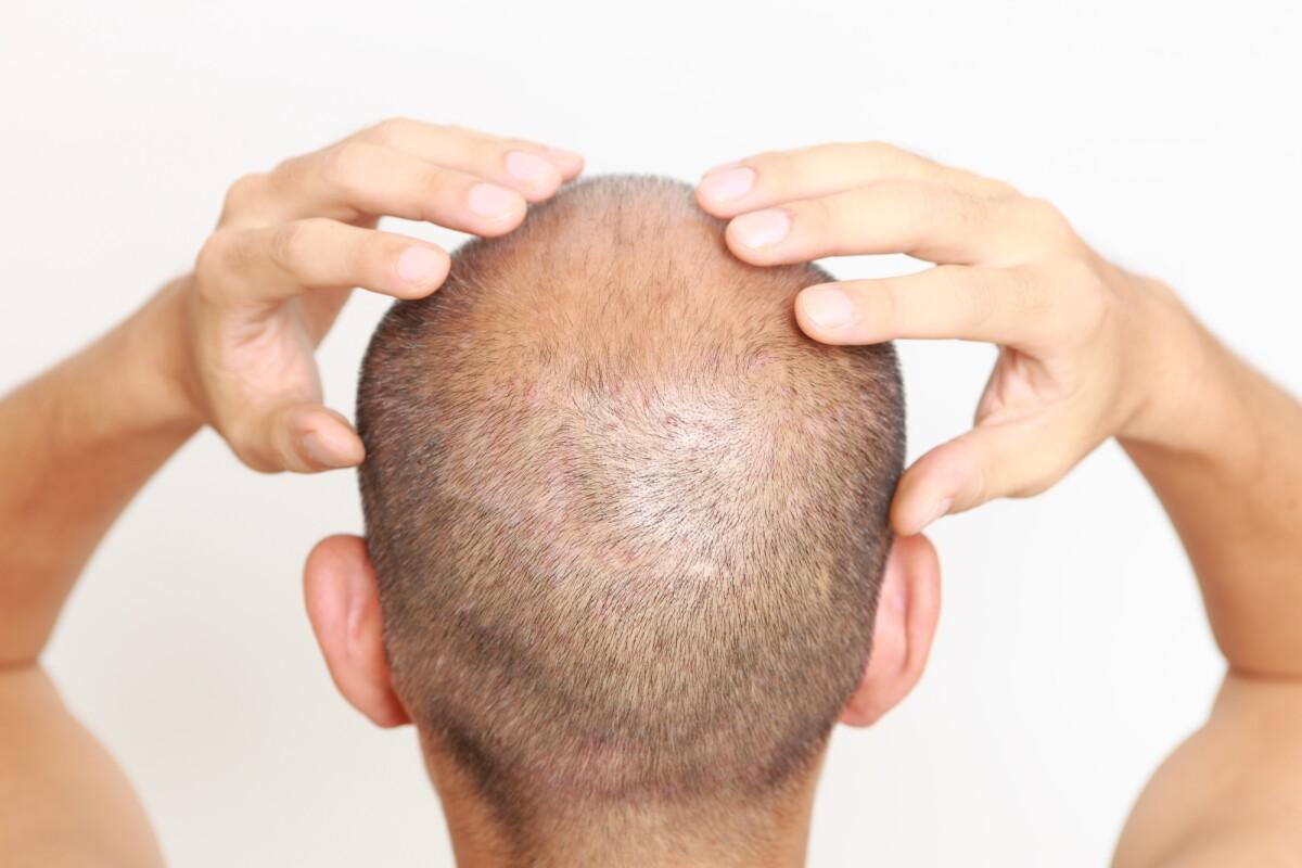 Who Is The Right Candidate For Crown Hair Transplant ? by Enfieldabudhabi