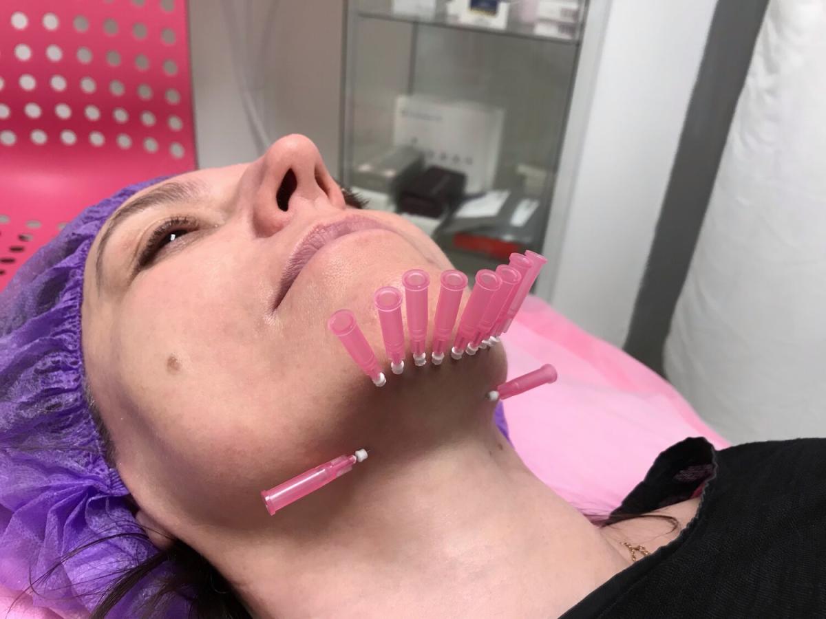 How Do PDO Mono Threads Support Skin Structure? by Dynamic Life Clinics