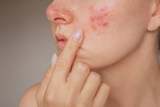 Can Acne Treatment Reduce Acne Without Harsh Medications? by Enfieldabudhabi