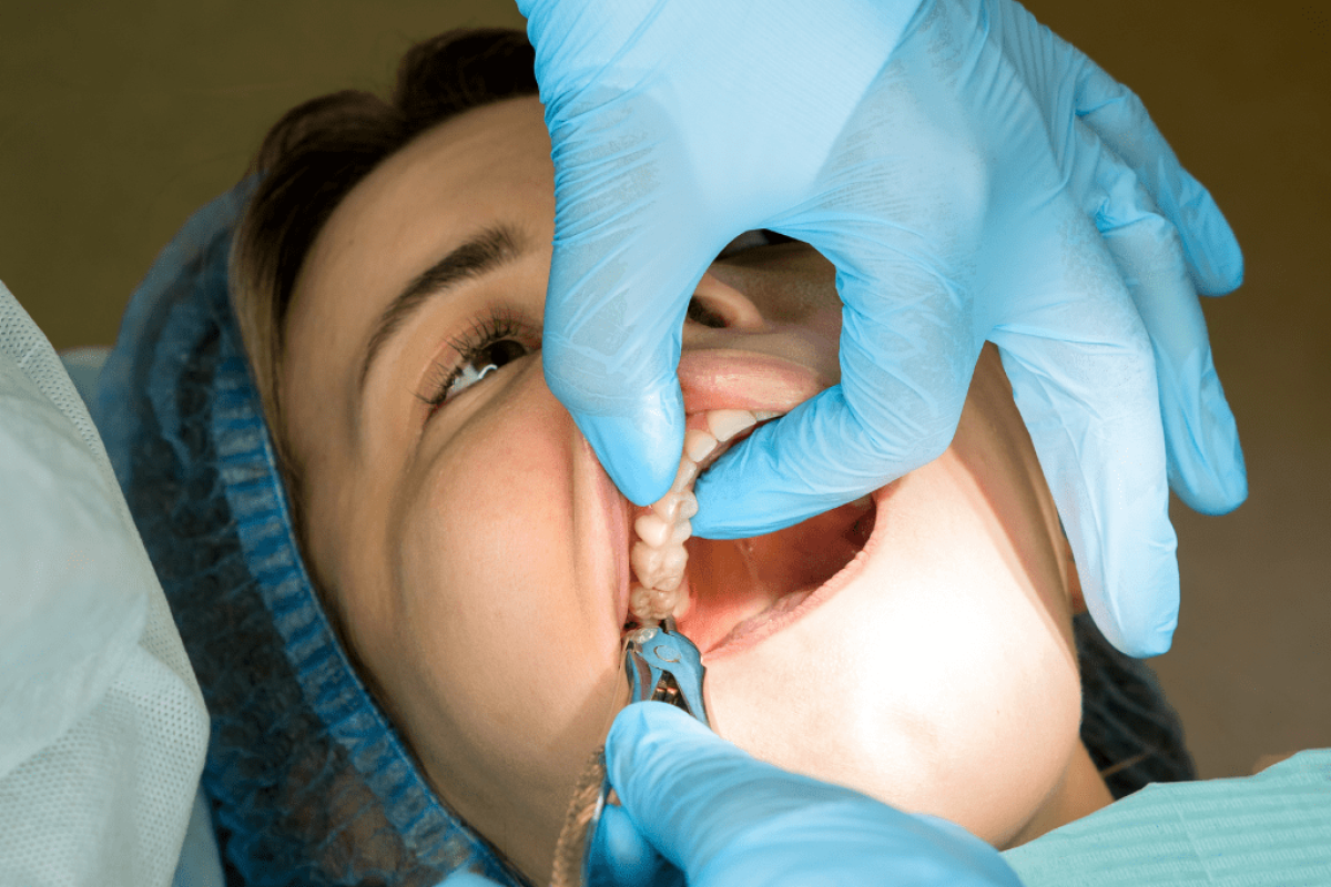 Dry Socket After Wisdom Tooth Removal: How To Prevent It by Aesthethic Clinic