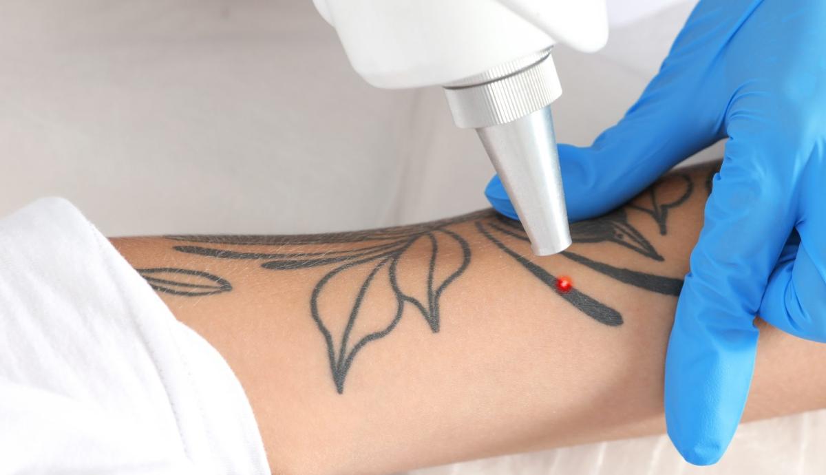 How Long Does Each Laser Tattoo Removal Session Take? by cdynmic