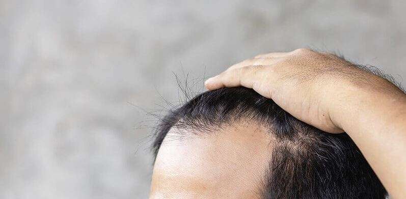 How Does FUSS Hair Transplant Address Receding Hairlines? How Does FUSS Hair Transplant Address Receding Hairlines? by MuhammadAhmad