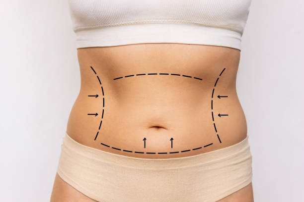 What Happens During Liposuction Body Refinement? by Enfieldabudhabi