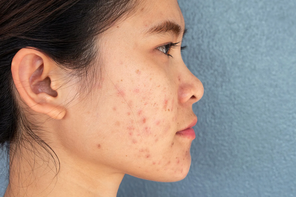 How Many RF Sessions Are Needed For Acne Scars? by fatimadynamic