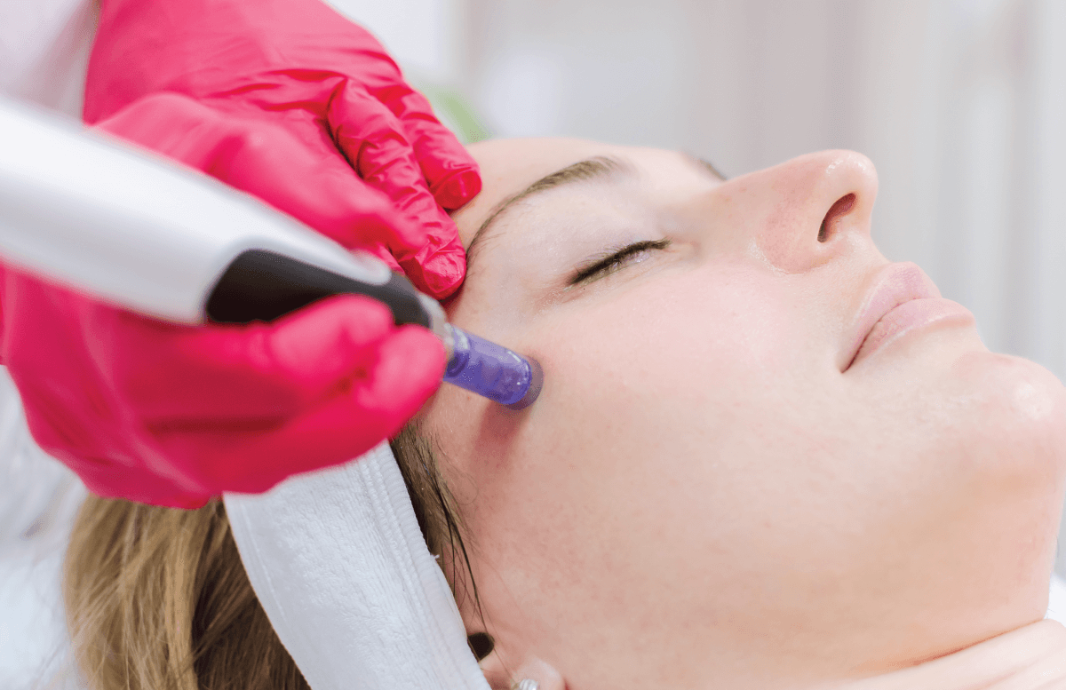 Is Microneedling Beneficial For Oily Or Acne-Prone Skin? by dynamicaesthetic