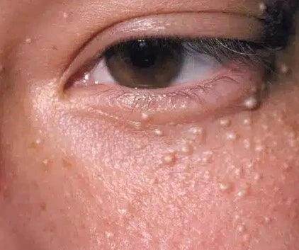 What Exactly Are Milia And How Can They Be Treated? by dynamicaesthetic