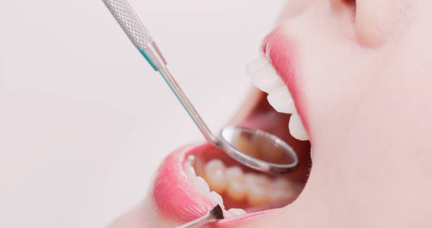 Insights Into Dental Filling Expenses by mominenfield