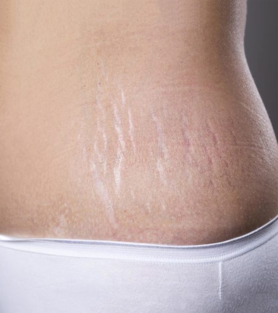 How Exactly Does Laser Stretch Mark Removal Work? by fatimadynamic