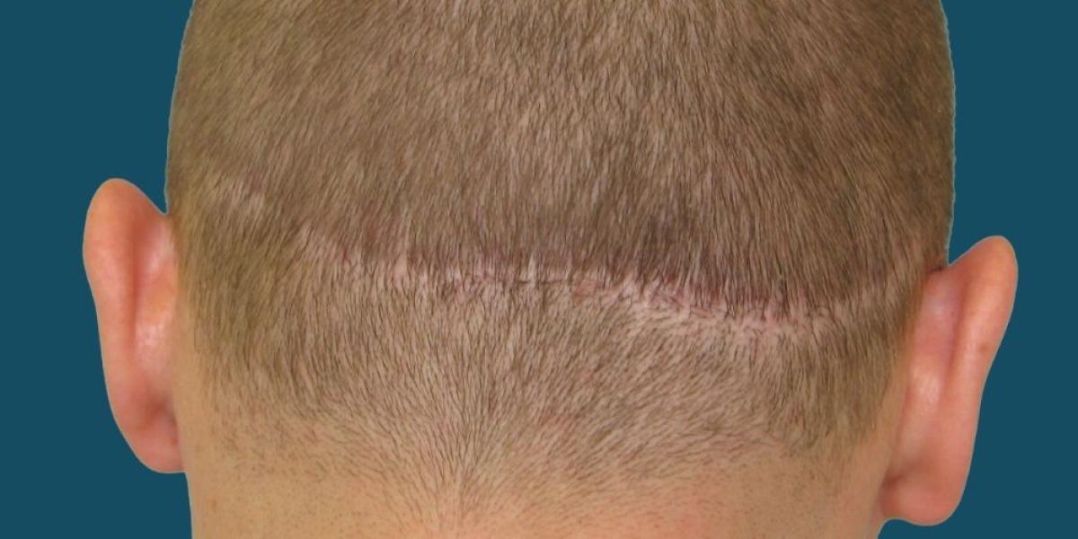 What Are The Advantages Of Choosing FUT Hair Transplant? by cdynmic
