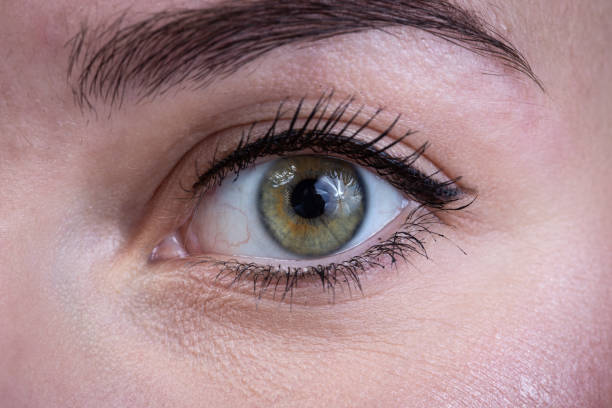 Does Eye Bag Removal Help Genetic Eye Bags? by Enfieldabudhabi