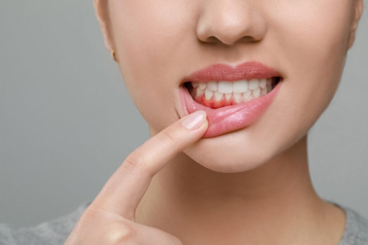 How To Heal Bleeding Gums After Brushing ? by Aesthethic Clinic