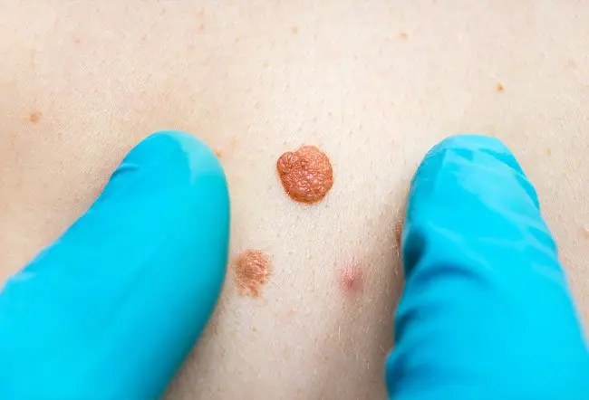 Is It Possible To Remove A Mole In Just One Treatment? by dynamicaesthetic