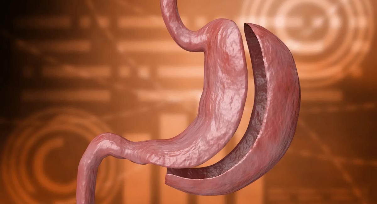 What Is The Standard Technique For Gastric Sleeve Surgery? What Is The Standard Technique For Gastric Sleeve Surgery? by MuhammadAhmad