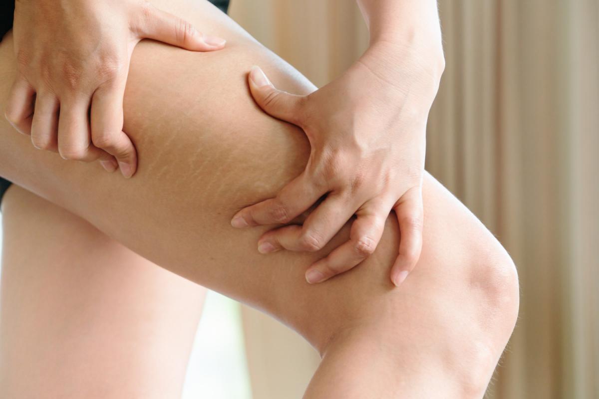 What To Expect During Laser Stretch Marks Removal Sessions? What To Expect During Laser Stretch Marks Removal Sessions? by MuhammadAhmad