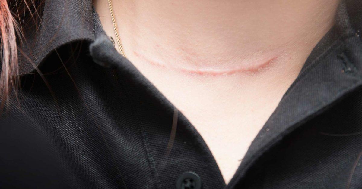 Is Laser Scar Removal Suitable For Surgical Scars? Is Laser Scar Removal Suitable For Surgical Scars? by MuhammadAhmad