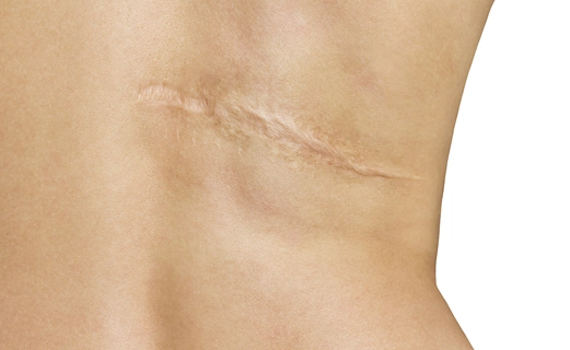 Enhance Your Skin Texture Fast Using Scar Removal Dubai by pookie46