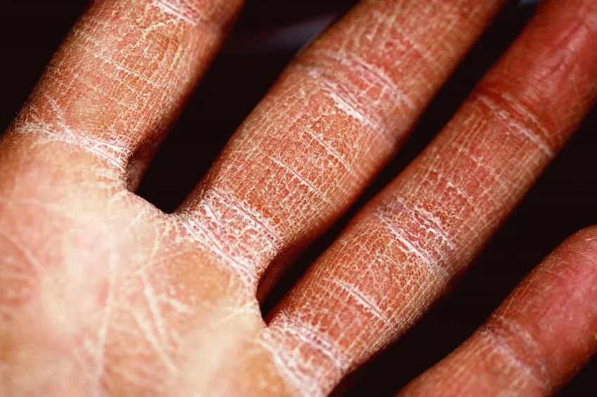 Dry Skin