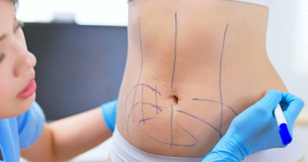 Understanding The Science Behind Lipo Abdominoplasty Surgery Effectiveness by enfieldroyalsaudi050