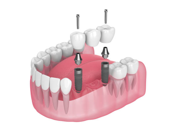 Can Dental Implants Replace Multiple Missing Teeth? by Enfieldabudhabi