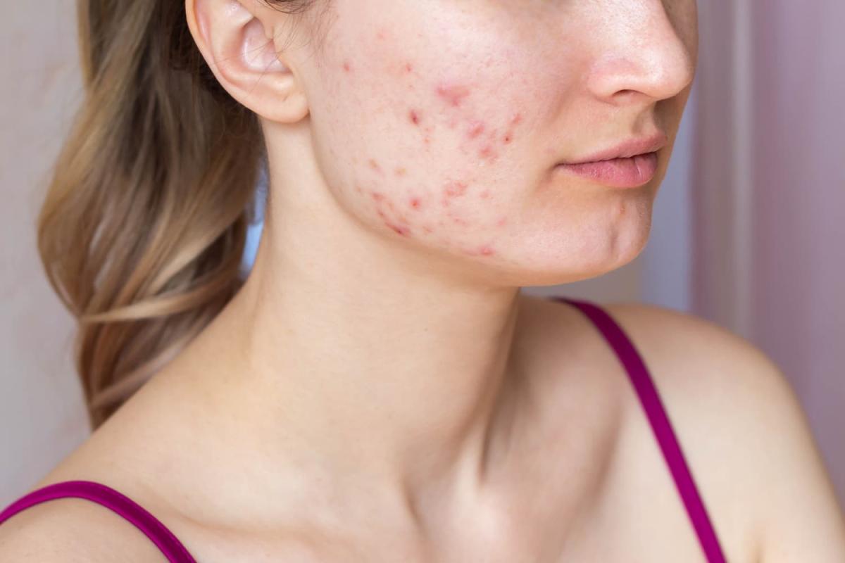 Boost Skin Smoothness Effortlessly With Acne Treatment Dubai by pookie46
