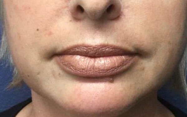 Can Volbella Correct Lip Asymmetry? by Dynamicclinic12