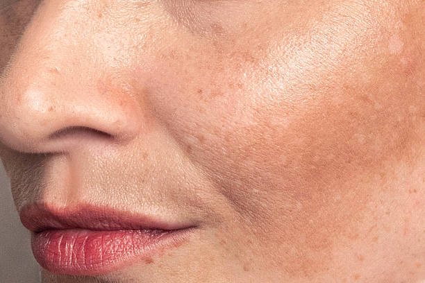 How Long Does Pigmentation Treatment Take To Show Results? by Enfieldabudhabi