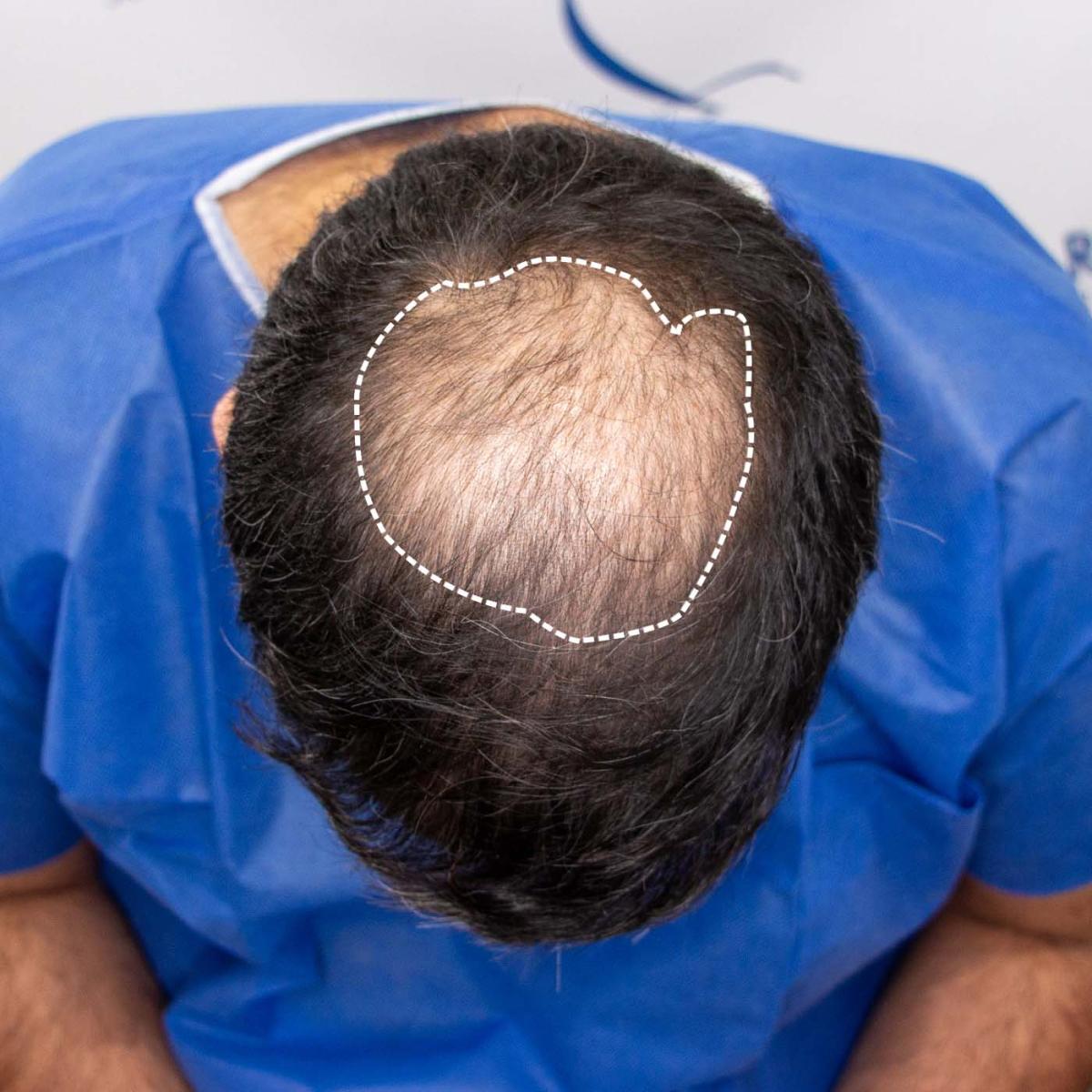What Are The Latest Techniques In Crown Hair Transplant? What Are The Latest Techniques In Crown Hair Transplant? by MuhammadAhmad