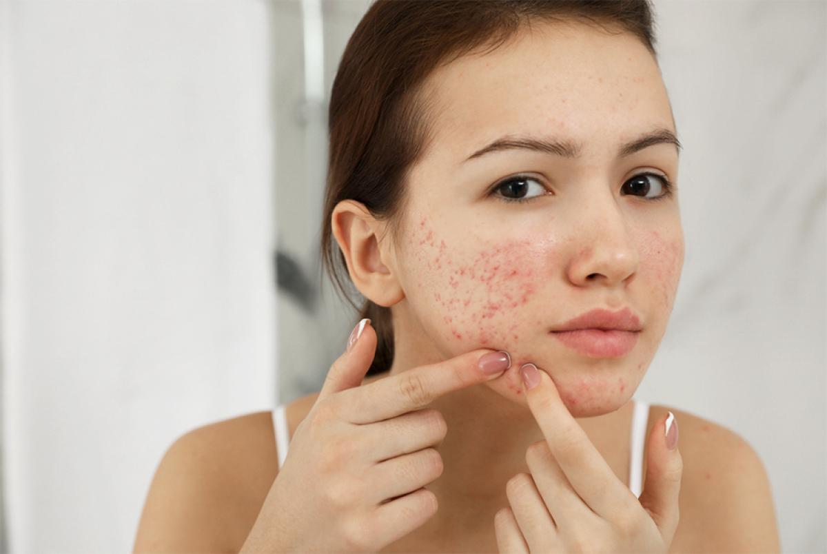 How To Prepare Your Skin Before Acne Scar Treatment How To Prepare Your Skin Before Acne Scar Treatment by MuhammadAhmad