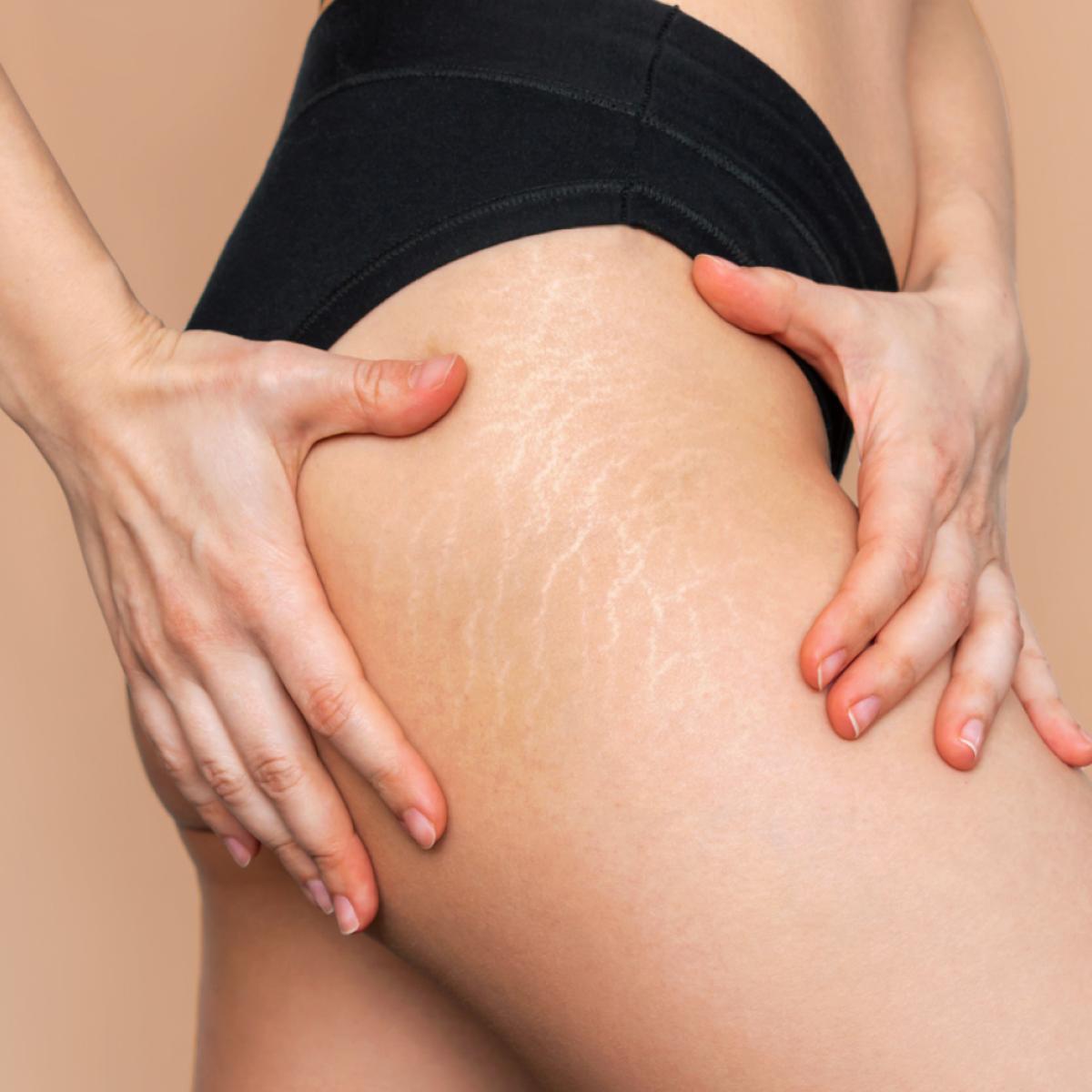 Who Is The Best Dermatologist For Stretch Marks? by dynamicaesthetic