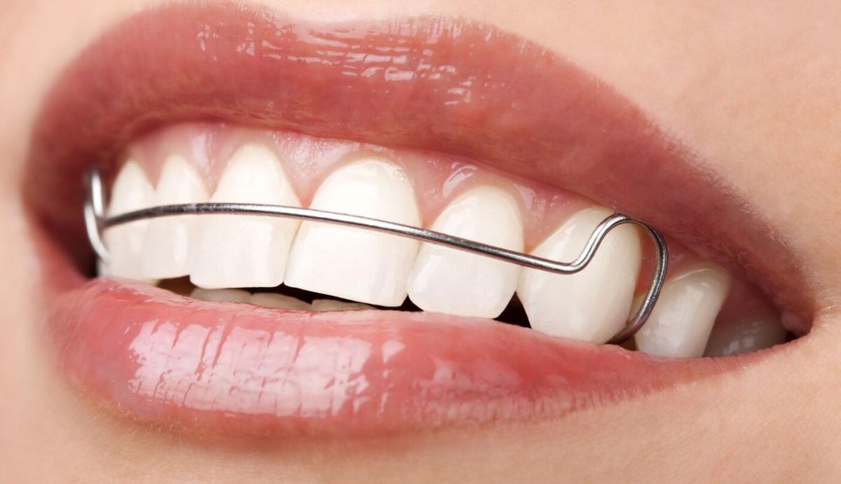 What Are The Signs Of A Dirty Retainer? by Aesthethic Clinic