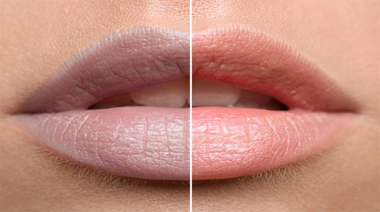 Transform Your Lip Tone Safely With Laser Treatment For Dark Lips by pookie46