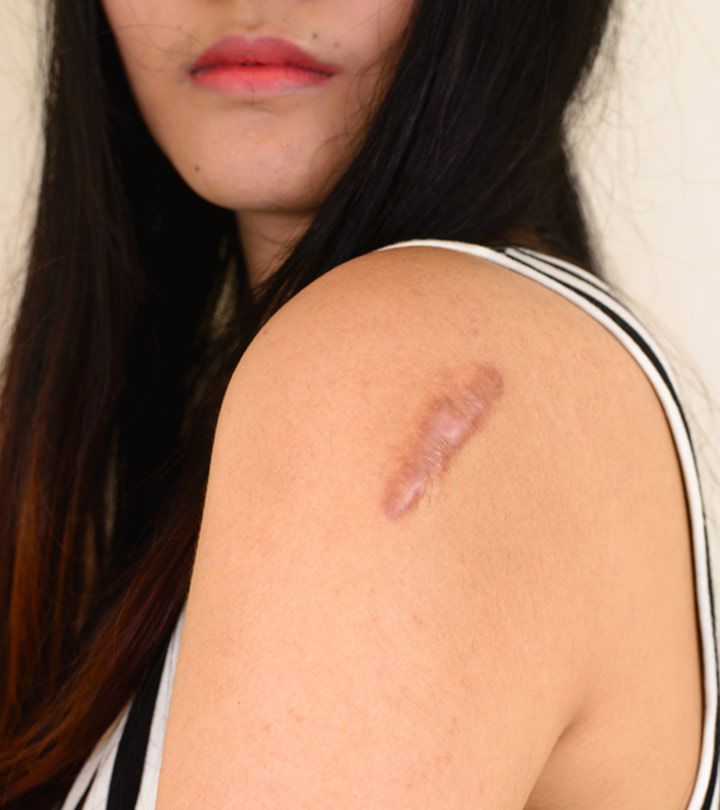 Can Keloid Treatment Even Out Rough Skin Texture? by Dynamic Life Clinics