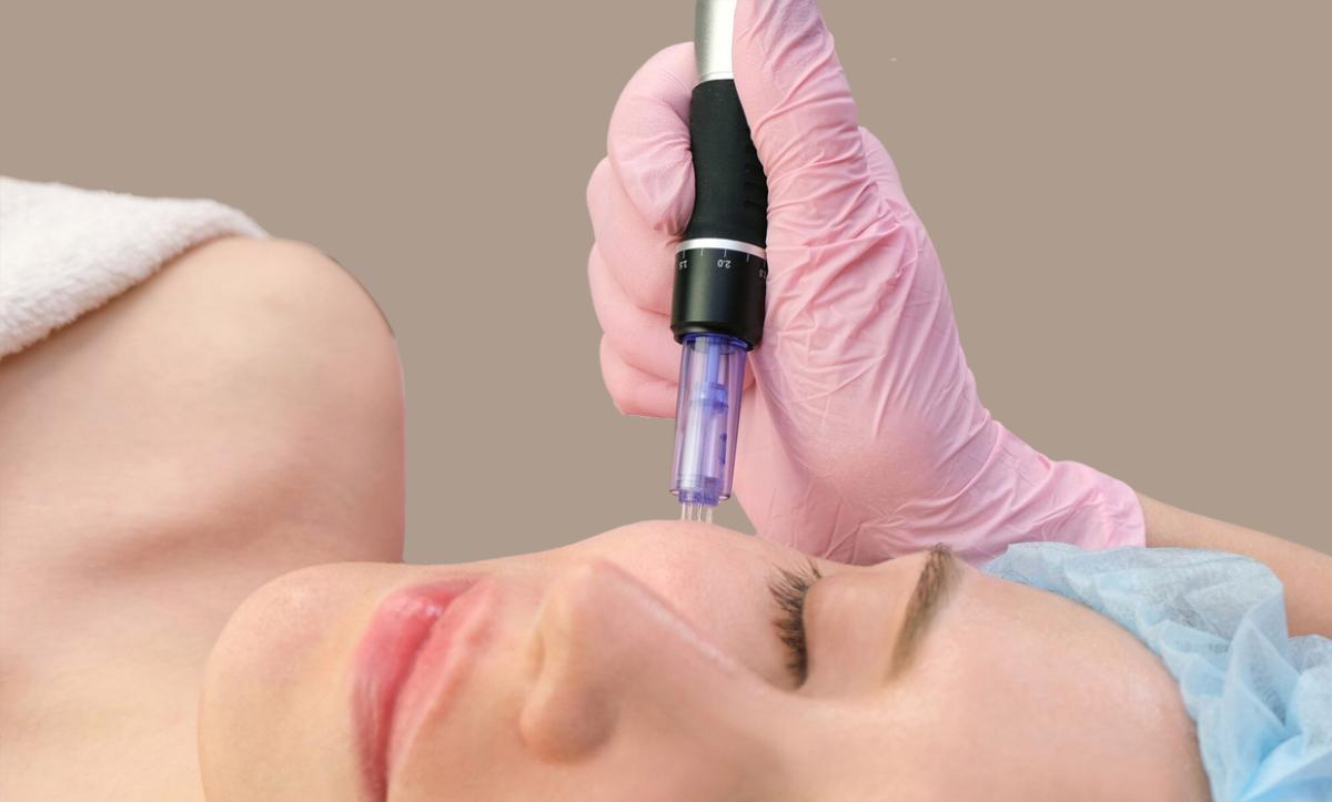 Does Microneedling Tighten Loose Skin? by dynamicaesthetic