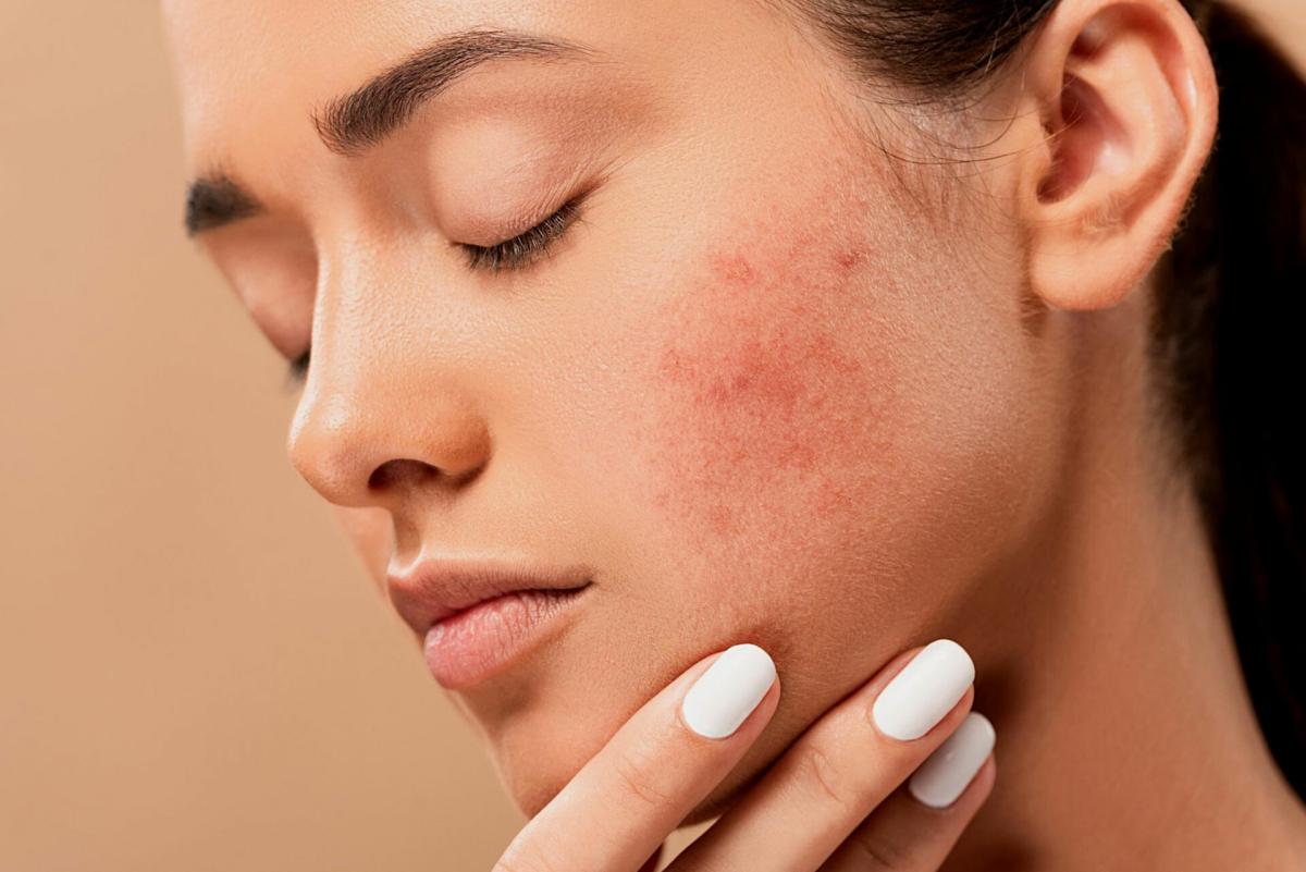 Can Pimples Treatment Remove Skin Discoloration Effectively? by Dynamic Life Clinics