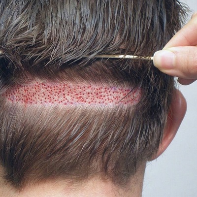 Shine Confidently Every Day With Hair Replacement Solutions by pookie46