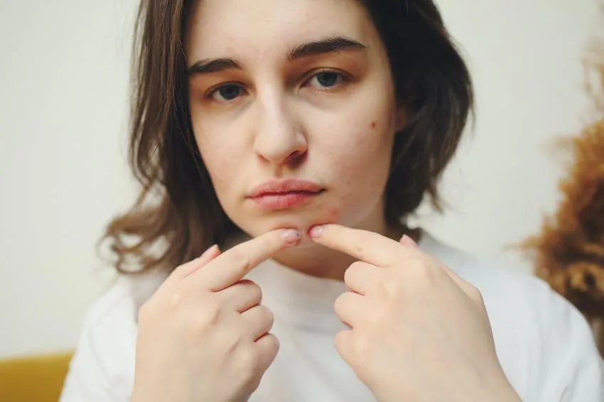 Rosacea Symptoms of rosacea