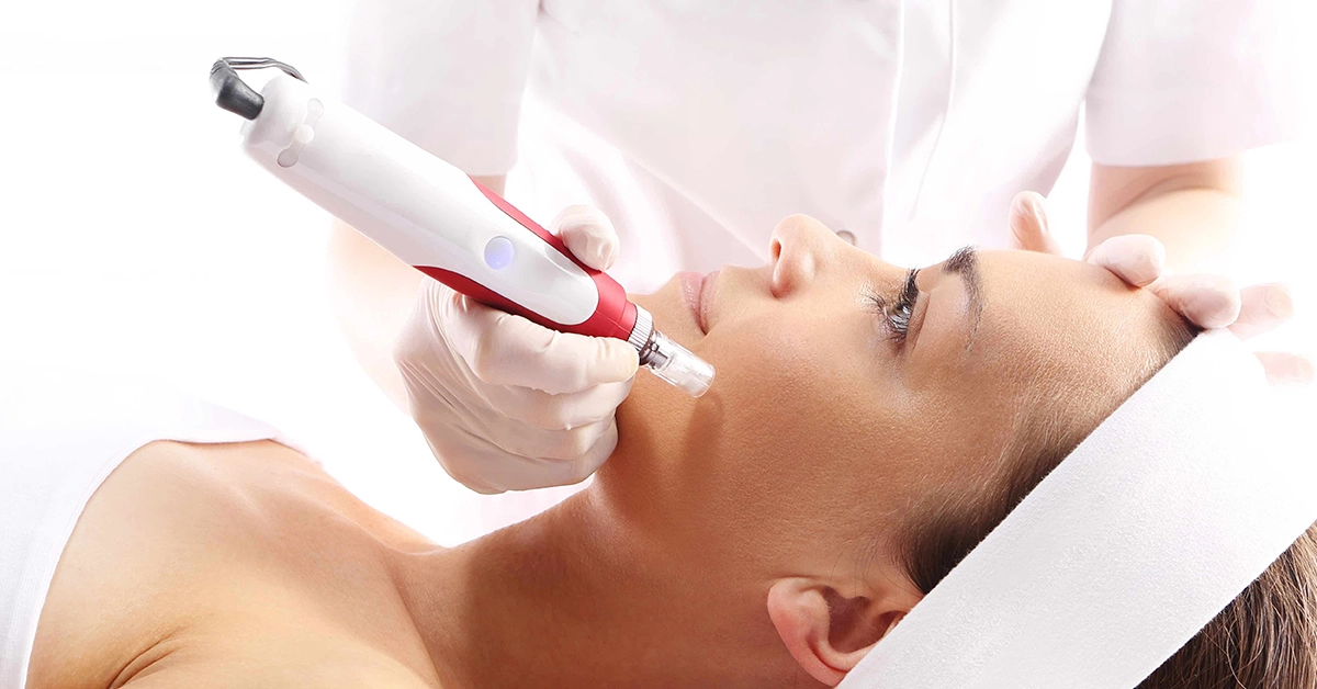 Is Microneedling Good For Rosacea-prone Skin? by fatimadynamic